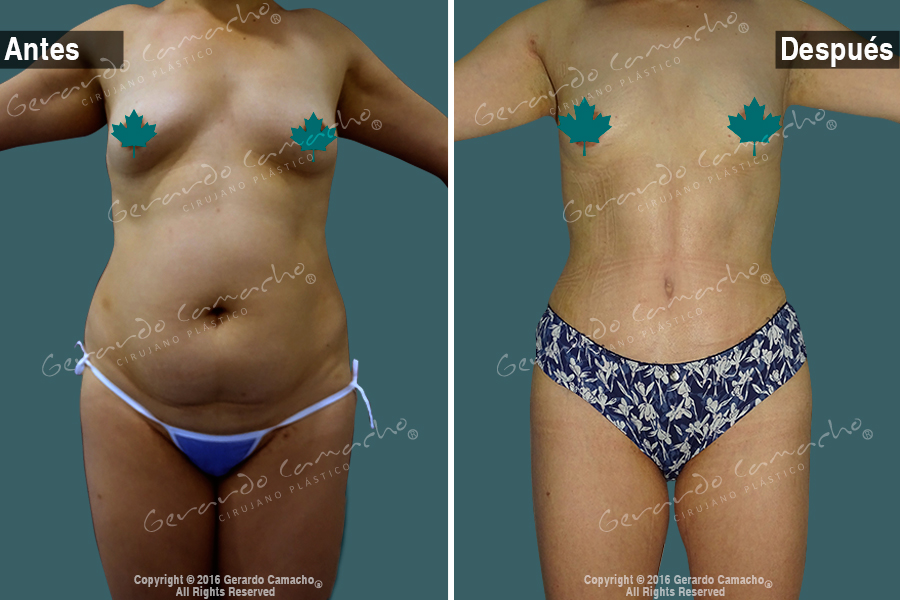 Resultados armónicos de abdominoplastia en Bogotá